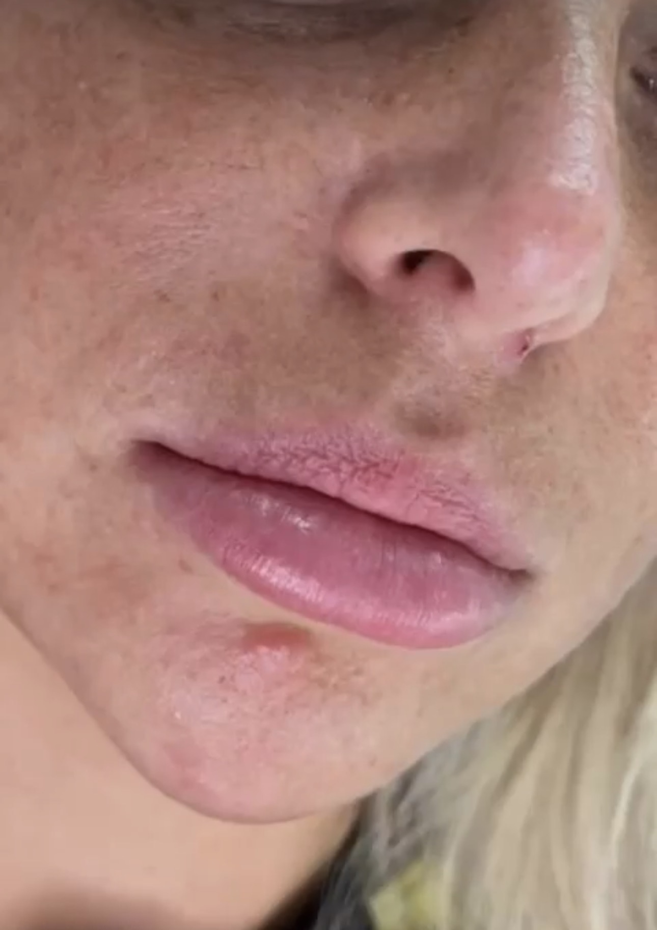 Lips before dermal filler enhancement